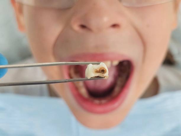Best Emergency Wisdom Teeth Removal in Columbia, PA