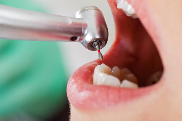 Best Emergency Dental Care for Broken or Chipped Teeth in Columbia, PA